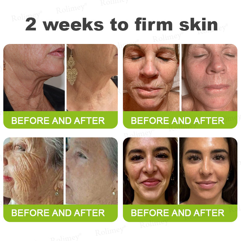 🔥 𝐅𝐥𝐚𝐬𝐡 𝐒𝐚𝐥𝐞: 𝟓𝟎% 𝐎𝐅𝐅 – 𝐑𝐨𝐥𝐢𝐦𝐞𝐲® 🧑‍⚕️ 𝐁𝐨𝐭𝐨𝐱-𝐋𝐢𝐤𝐞 𝐏𝐞𝐩𝐭𝐢𝐝𝐞𝐬 + 𝐕𝐢𝐭𝐚-𝐀 𝐑𝐞𝐭𝐢𝐧𝐨𝐥 𝐒𝐡𝐨𝐭 – 𝐖𝐫𝐢𝐧𝐤𝐥𝐞-𝐋𝐢𝐟𝐭 𝐓𝐢𝐠𝐡𝐭𝐞𝐧𝐢𝐧𝐠 𝐂𝐫𝐞𝐚𝐦
