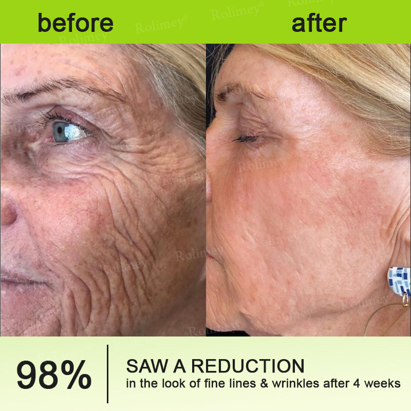 🔥 𝐅𝐥𝐚𝐬𝐡 𝐒𝐚𝐥𝐞: 𝟓𝟎% 𝐎𝐅𝐅 – 𝐑𝐨𝐥𝐢𝐦𝐞𝐲® 🧑‍⚕️ 𝐁𝐨𝐭𝐨𝐱-𝐋𝐢𝐤𝐞 𝐏𝐞𝐩𝐭𝐢𝐝𝐞𝐬 + 𝐕𝐢𝐭𝐚-𝐀 𝐑𝐞𝐭𝐢𝐧𝐨𝐥 𝐒𝐡𝐨𝐭 – 𝐖𝐫𝐢𝐧𝐤𝐥𝐞-𝐋𝐢𝐟𝐭 𝐓𝐢𝐠𝐡𝐭𝐞𝐧𝐢𝐧𝐠 𝐂𝐫𝐞𝐚𝐦
