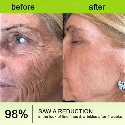 🔥 𝐅𝐥𝐚𝐬𝐡 𝐒𝐚𝐥𝐞: 𝟓𝟎% 𝐎𝐅𝐅 – 𝐑𝐨𝐥𝐢𝐦𝐞𝐲® 🧑‍⚕️ 𝐁𝐨𝐭𝐨𝐱-𝐋𝐢𝐤𝐞 𝐏𝐞𝐩𝐭𝐢𝐝𝐞𝐬 + 𝐕𝐢𝐭𝐚-𝐀 𝐑𝐞𝐭𝐢𝐧𝐨𝐥 𝐒𝐡𝐨𝐭 – 𝐖𝐫𝐢𝐧𝐤𝐥𝐞-𝐋𝐢𝐟𝐭 𝐓𝐢𝐠𝐡𝐭𝐞𝐧𝐢𝐧𝐠 𝐂𝐫𝐞𝐚𝐦
