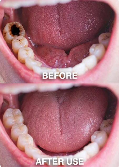 🧑‍⚕️Rolimey® DenPerm Cavity-Repair Natural Enamel Filling Gel